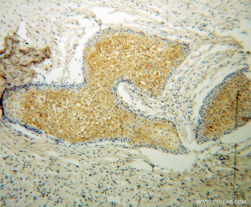 Immunohistochemistry (IHC) staining of human osteosarcoma tissue using CAT-1 Polyclonal antibody (14195-1-AP)