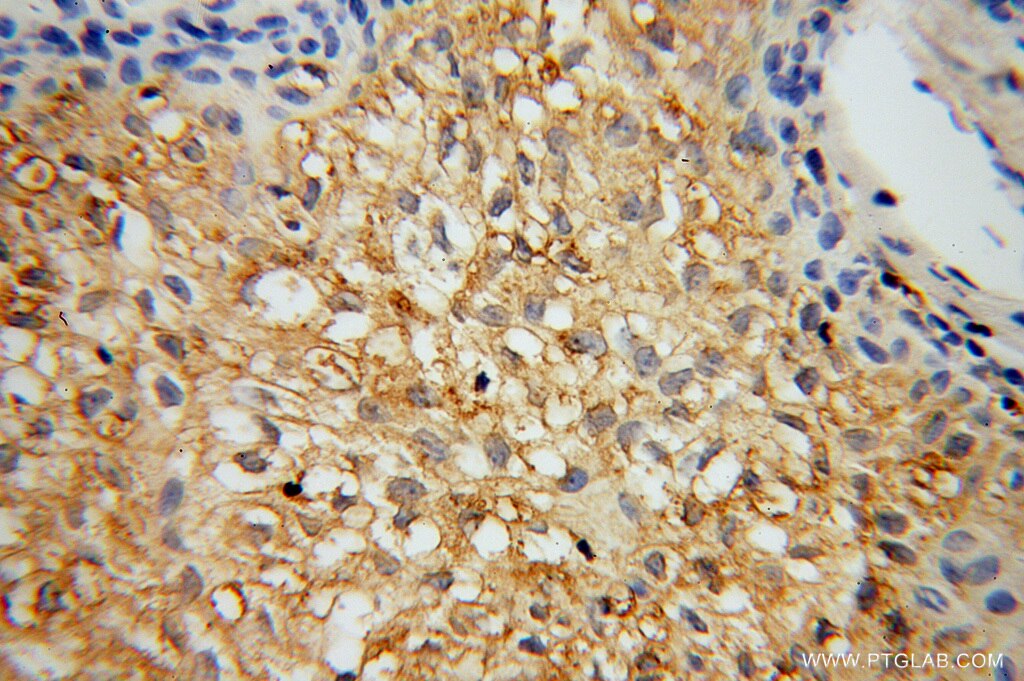 Immunohistochemistry (IHC) staining of human osteosarcoma tissue using CAT-1 Polyclonal antibody (14195-1-AP)