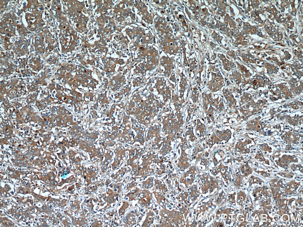 Immunohistochemistry (IHC) staining of human stomach cancer tissue using SLC7A5 Polyclonal antibody (13752-1-AP)