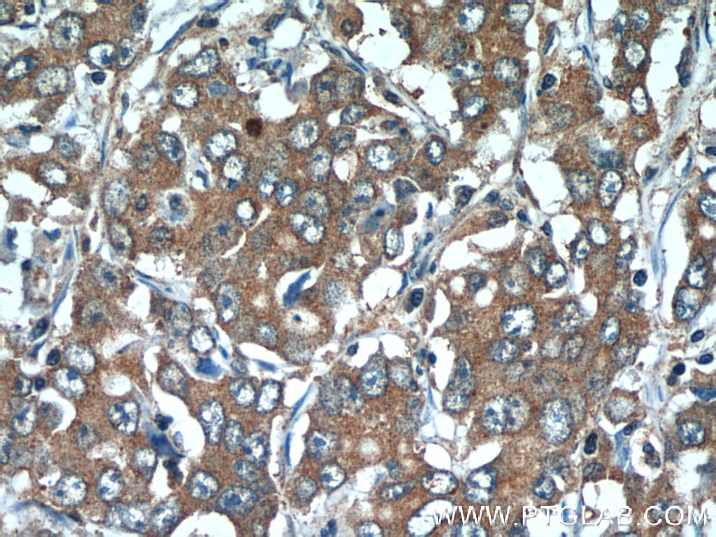 Immunohistochemistry (IHC) staining of human stomach cancer tissue using SLC7A5 Polyclonal antibody (13752-1-AP)