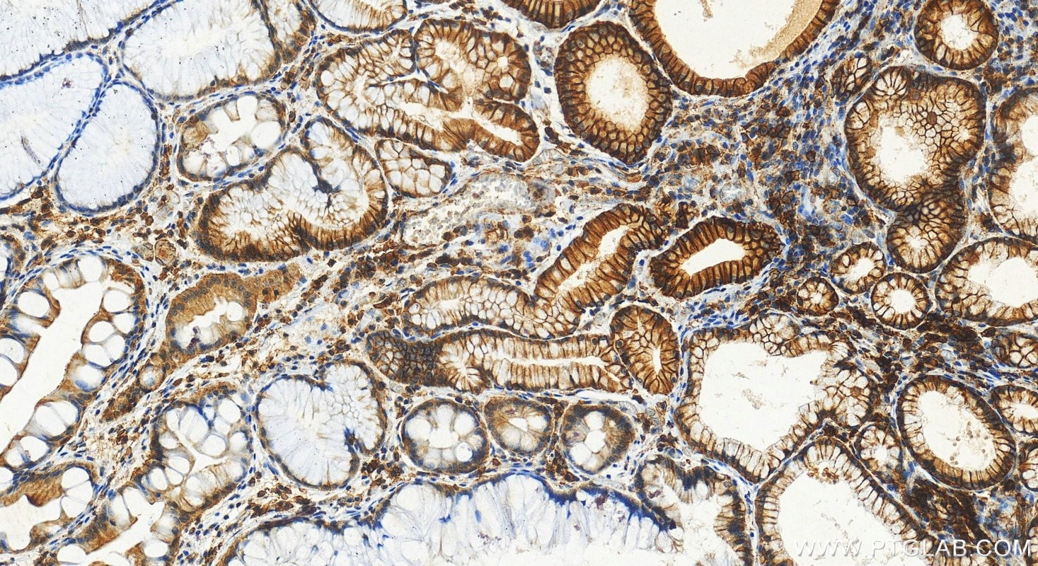 Immunohistochemistry (IHC) staining of human stomach cancer tissue using SLC7A5 Polyclonal antibody (28670-1-AP)
