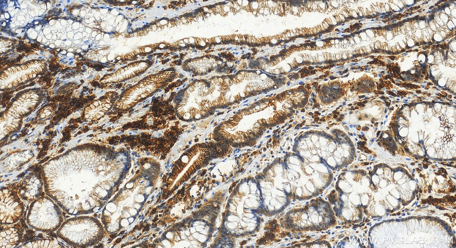 Immunohistochemistry (IHC) staining of human stomach cancer tissue using SLC7A5 Polyclonal antibody (28670-1-AP)