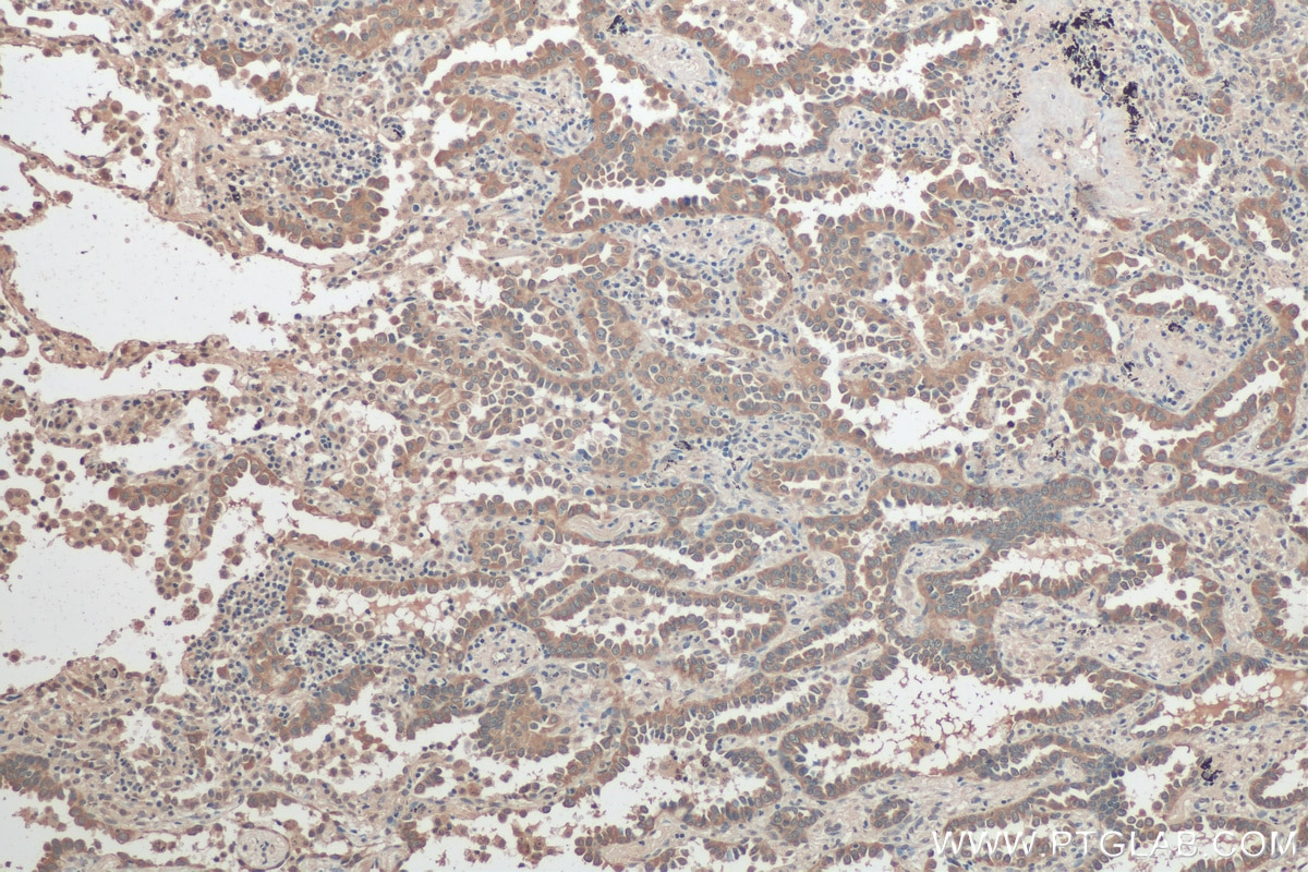 Immunohistochemistry (IHC) staining of human lung cancer tissue using SLC7A5 Polyclonal antibody (28670-1-AP)