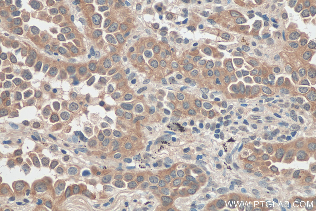 Immunohistochemistry (IHC) staining of human lung cancer tissue using SLC7A5 Polyclonal antibody (28670-1-AP)