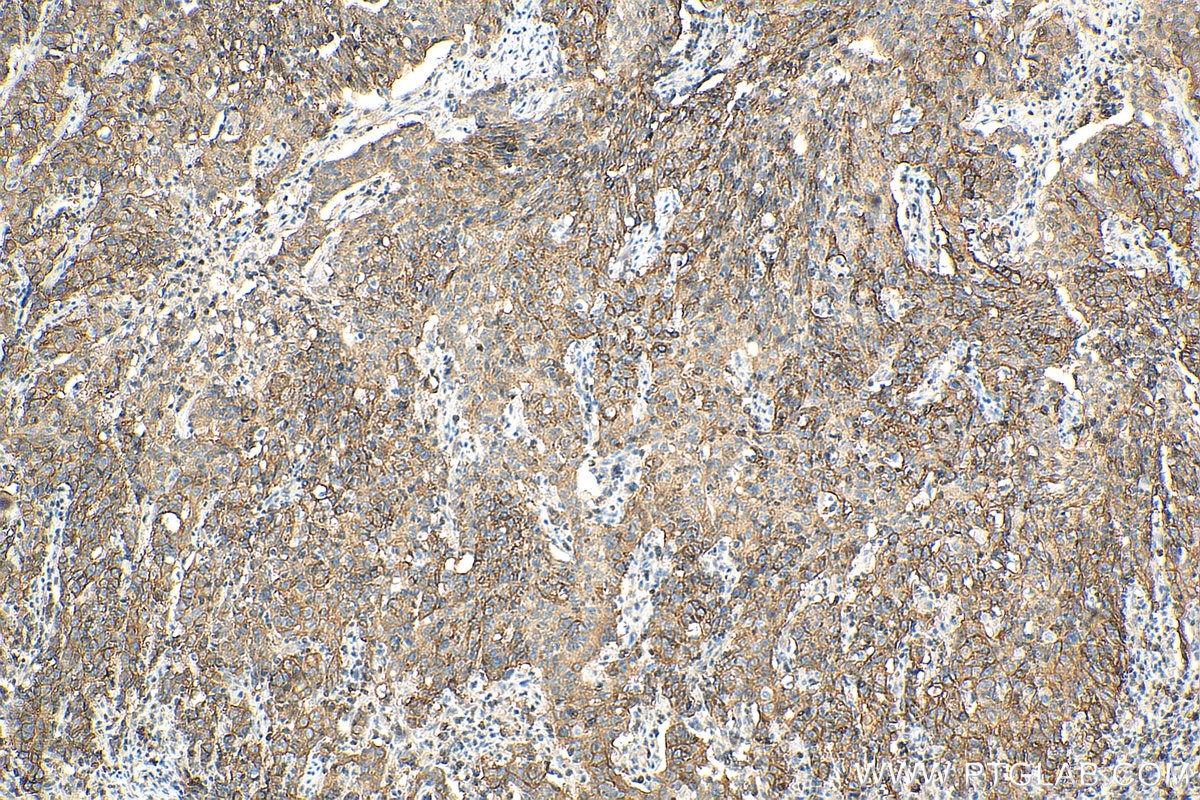 Immunohistochemistry (IHC) staining of human stomach cancer tissue using SLC7A5 Polyclonal antibody (28670-1-AP)