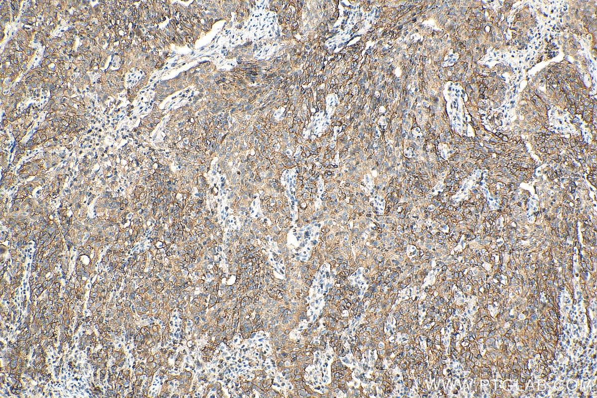 IHC staining of human stomach cancer using 28670-1-AP