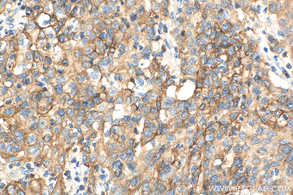 Immunohistochemistry (IHC) staining of human stomach cancer tissue using SLC7A5 Polyclonal antibody (28670-1-AP)