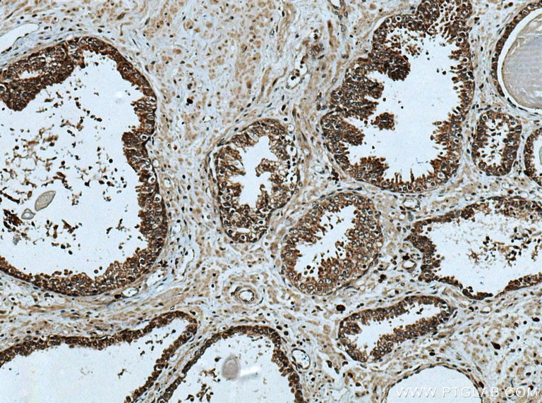 Immunohistochemistry (IHC) staining of human prostate cancer tissue using SLC7A6 Polyclonal antibody (13823-1-AP)