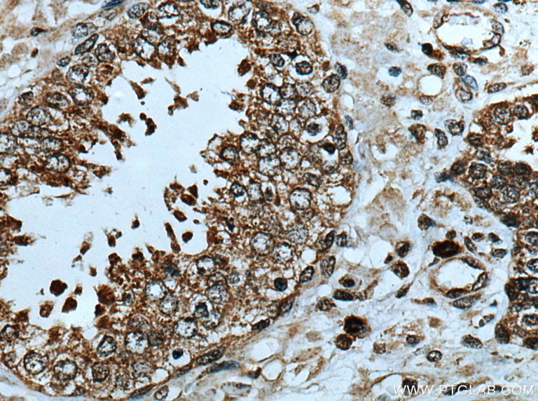 Immunohistochemistry (IHC) staining of human prostate cancer tissue using SLC7A6 Polyclonal antibody (13823-1-AP)