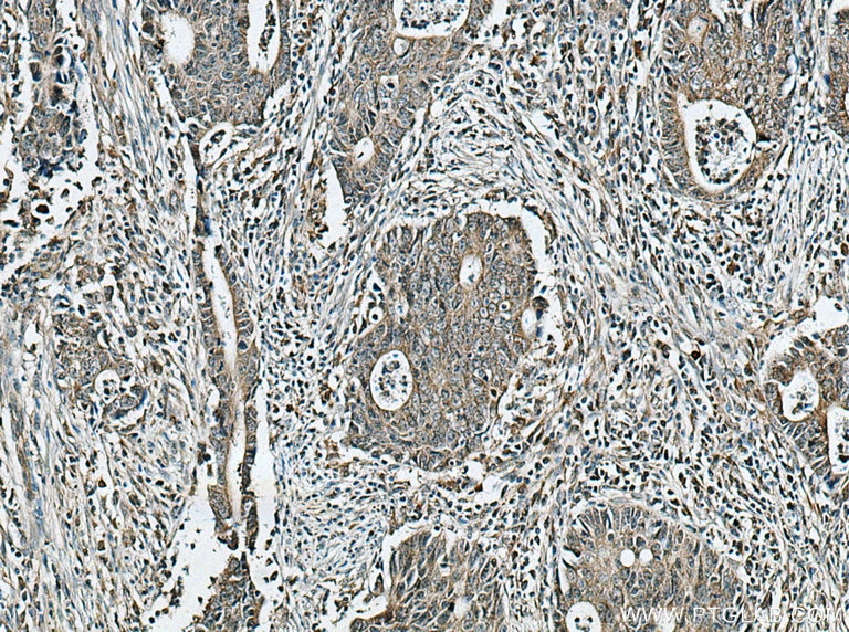 Immunohistochemistry (IHC) staining of human colon cancer tissue using SLC7A6 Polyclonal antibody (13823-1-AP)