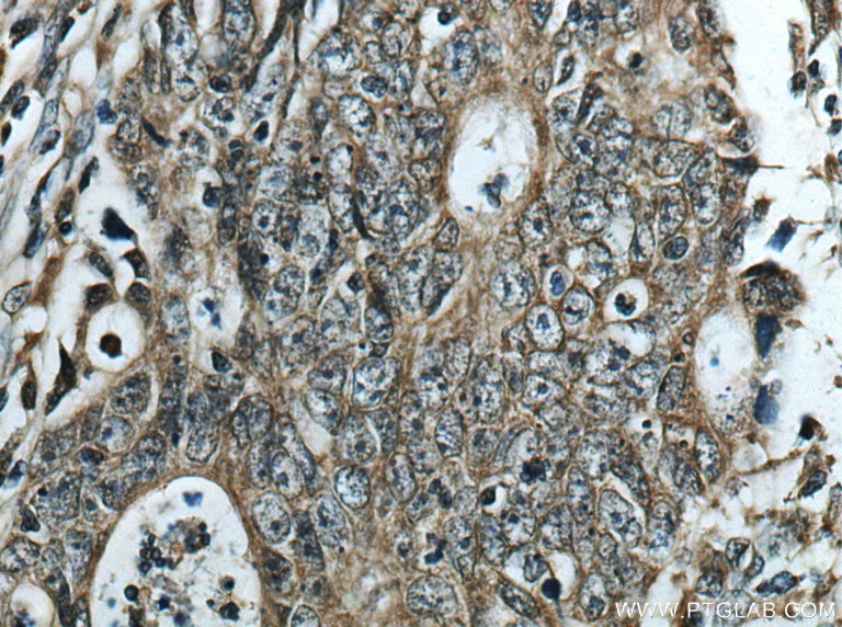 Immunohistochemistry (IHC) staining of human colon cancer tissue using SLC7A6 Polyclonal antibody (13823-1-AP)