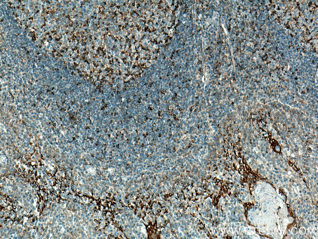 Immunohistochemistry (IHC) staining of human tonsillitis tissue using SLC9A9 Polyclonal antibody (13718-1-AP)