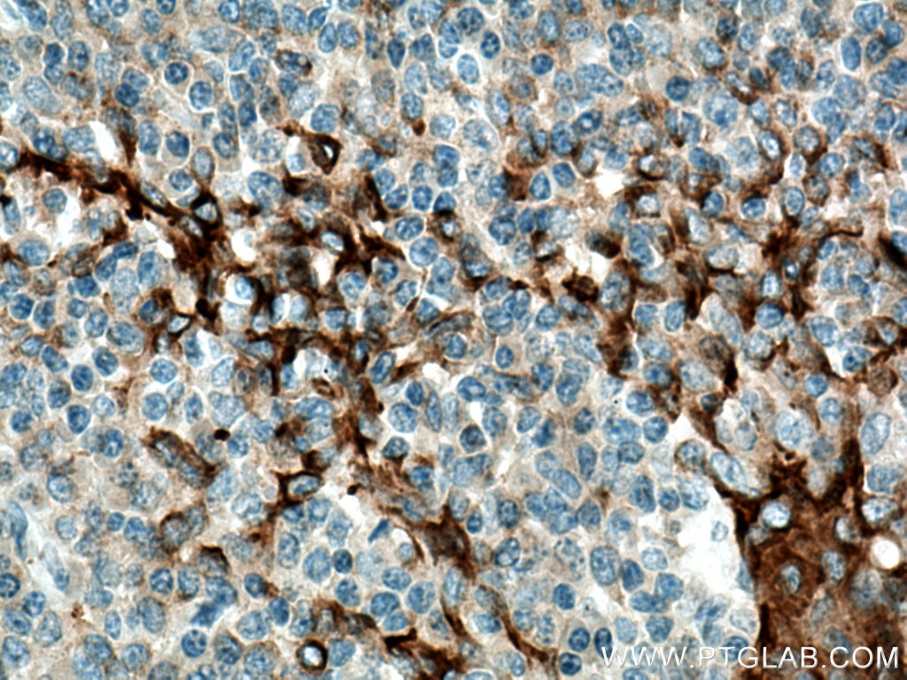 Immunohistochemistry (IHC) staining of human tonsillitis tissue using SLC9A9 Polyclonal antibody (13718-1-AP)