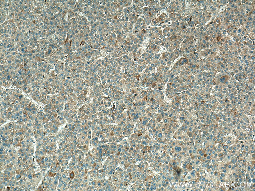 Immunohistochemistry (IHC) staining of human liver cancer tissue using SLC9A9 Polyclonal antibody (13718-1-AP)