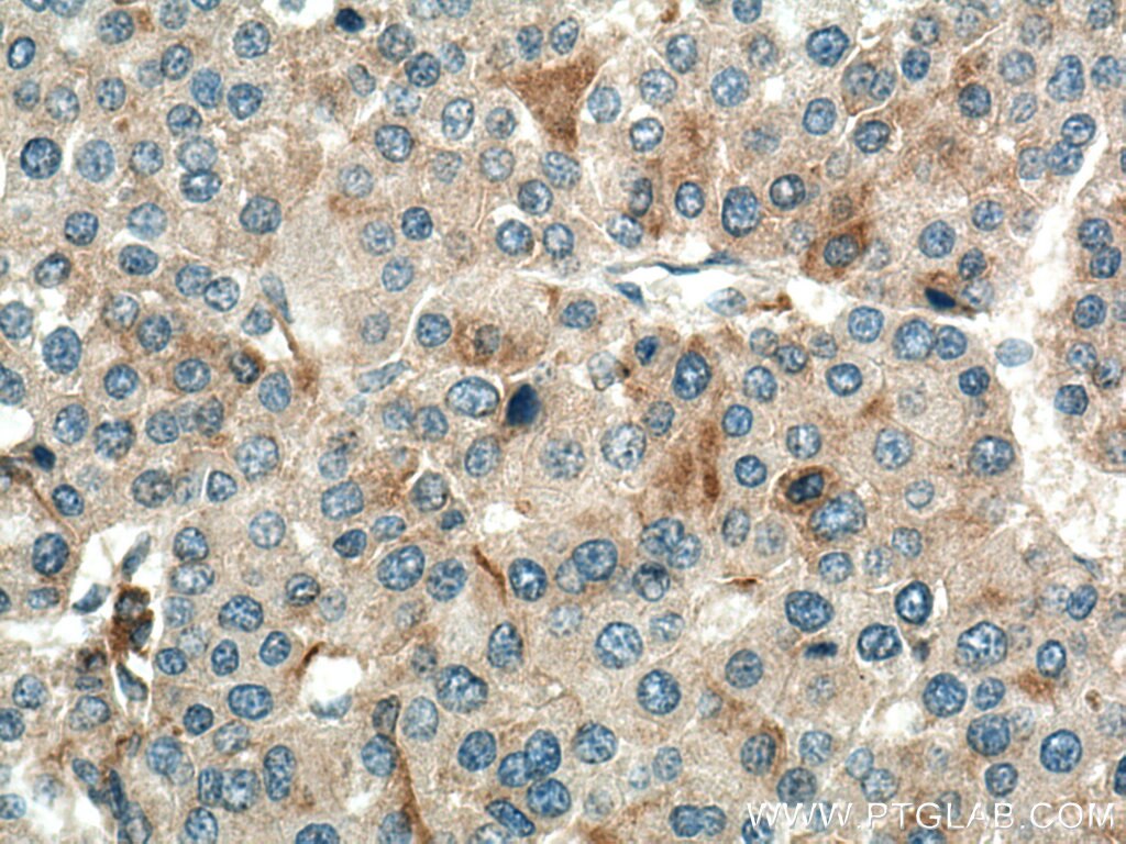 Immunohistochemistry (IHC) staining of human liver cancer tissue using SLC9A9 Polyclonal antibody (13718-1-AP)