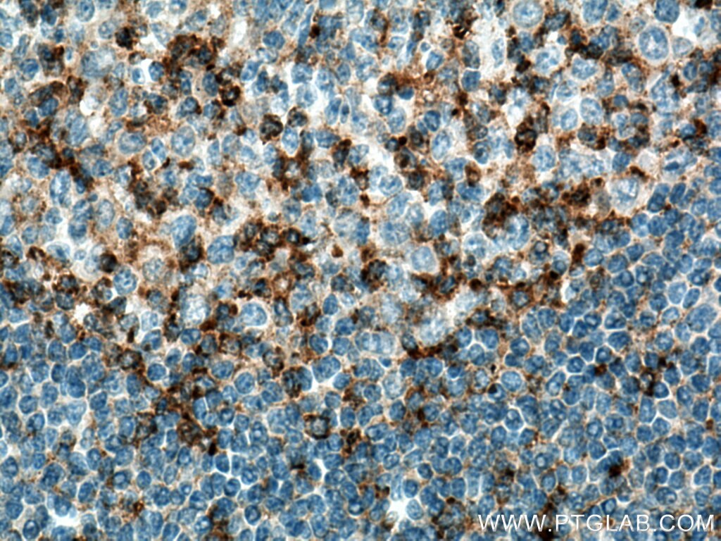 IHC staining of human tonsillitis using 13718-1-AP