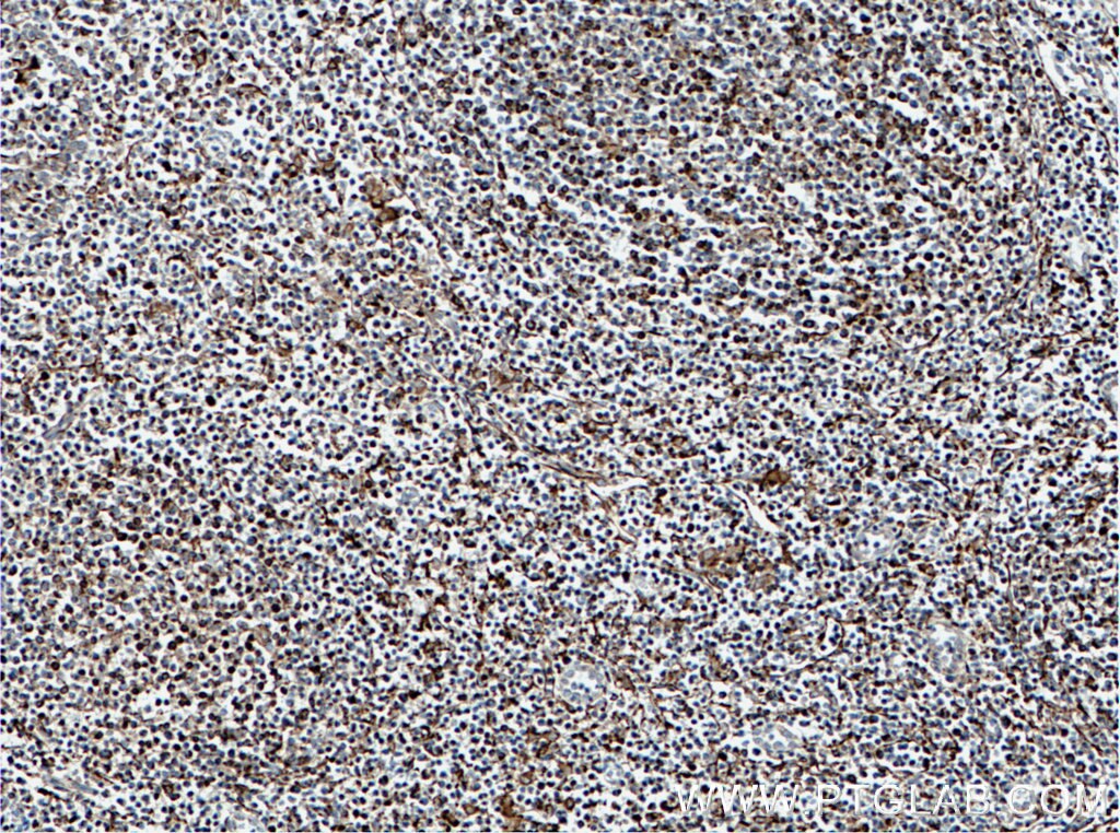 IHC staining of human tonsillitis using 66577-1-Ig