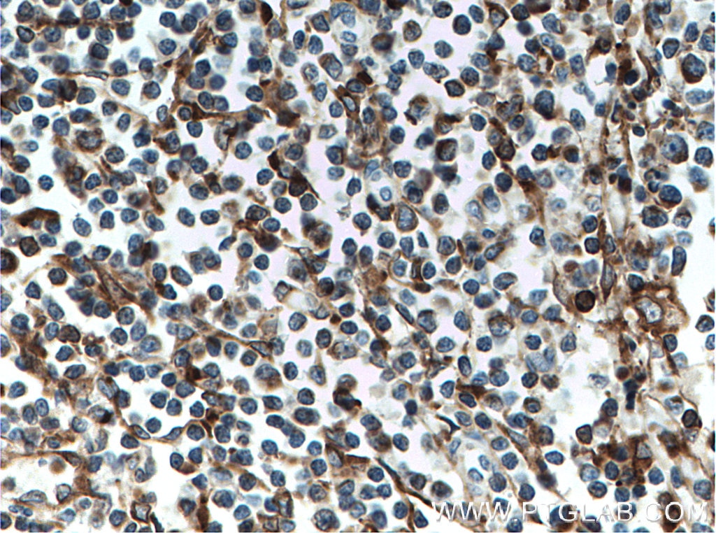 Immunohistochemistry (IHC) staining of human tonsillitis tissue using SLC9A9 Monoclonal antibody (66577-1-Ig)