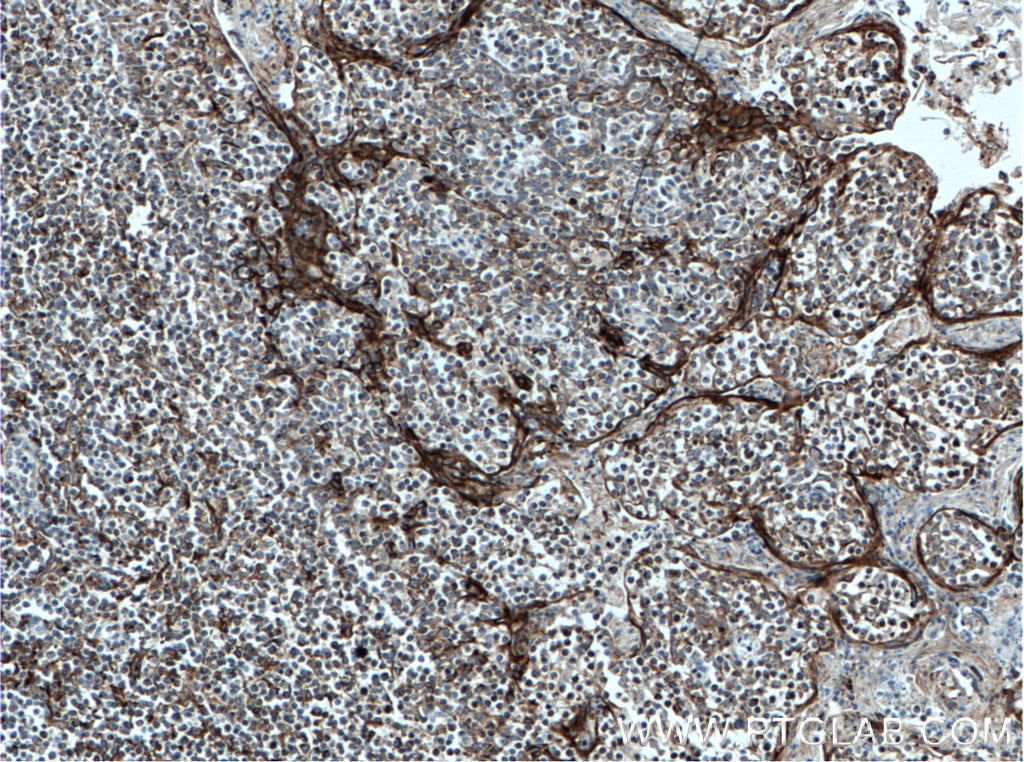 IHC staining of human tonsillitis using 66577-1-Ig