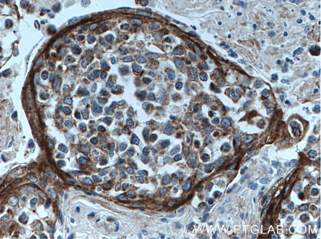 IHC staining of human tonsillitis using 66577-1-Ig