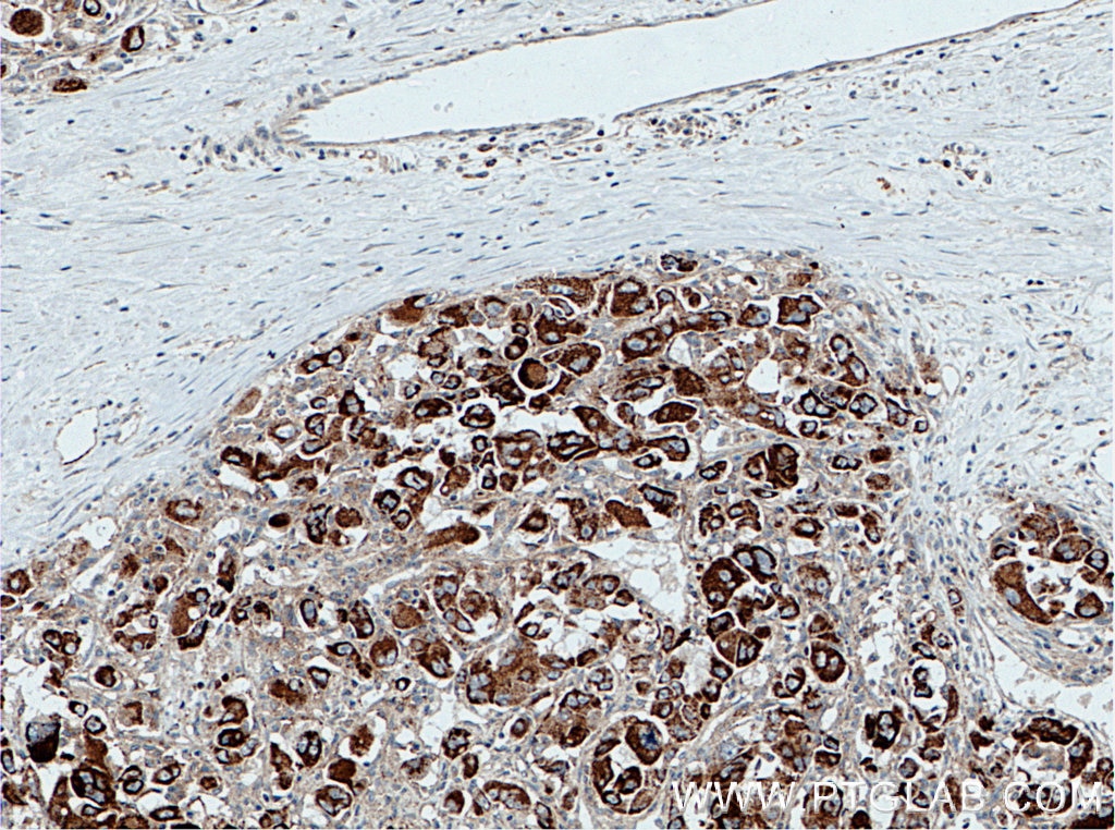 Immunohistochemistry (IHC) staining of human liver cancer tissue using SLC9A9 Monoclonal antibody (66577-1-Ig)