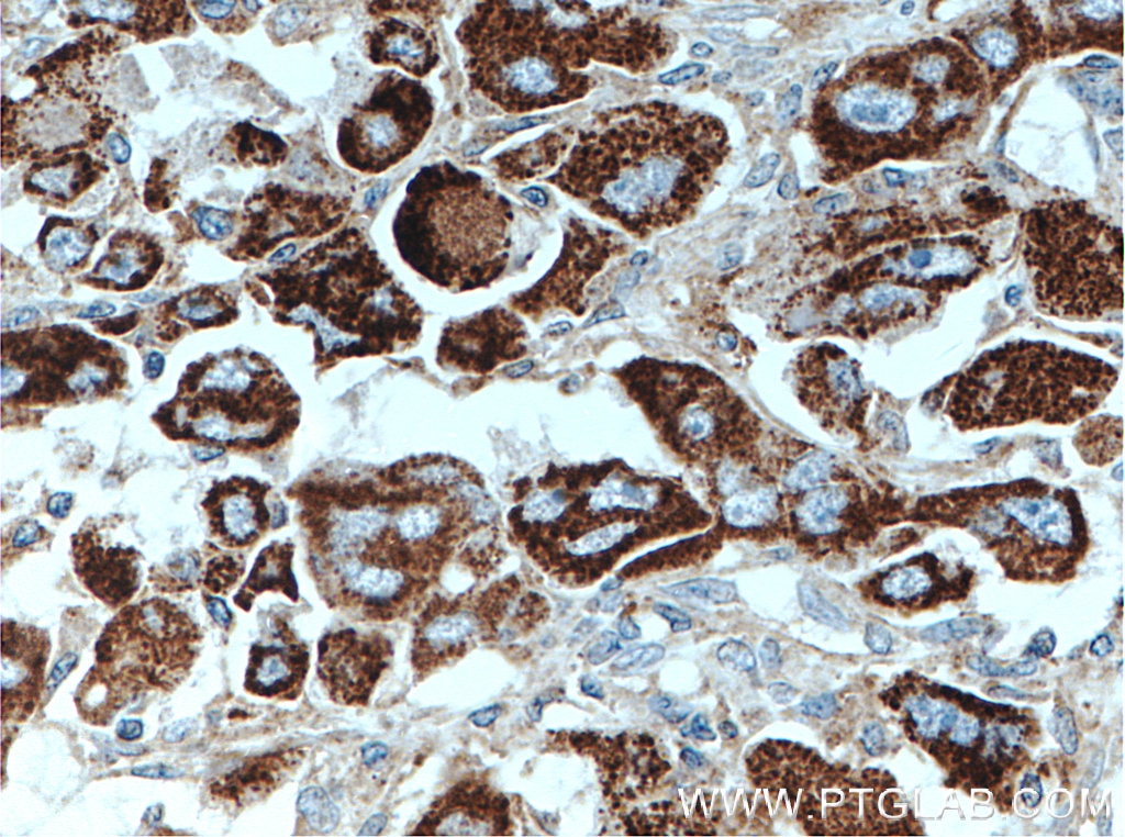 IHC staining of human liver cancer using 66577-1-Ig