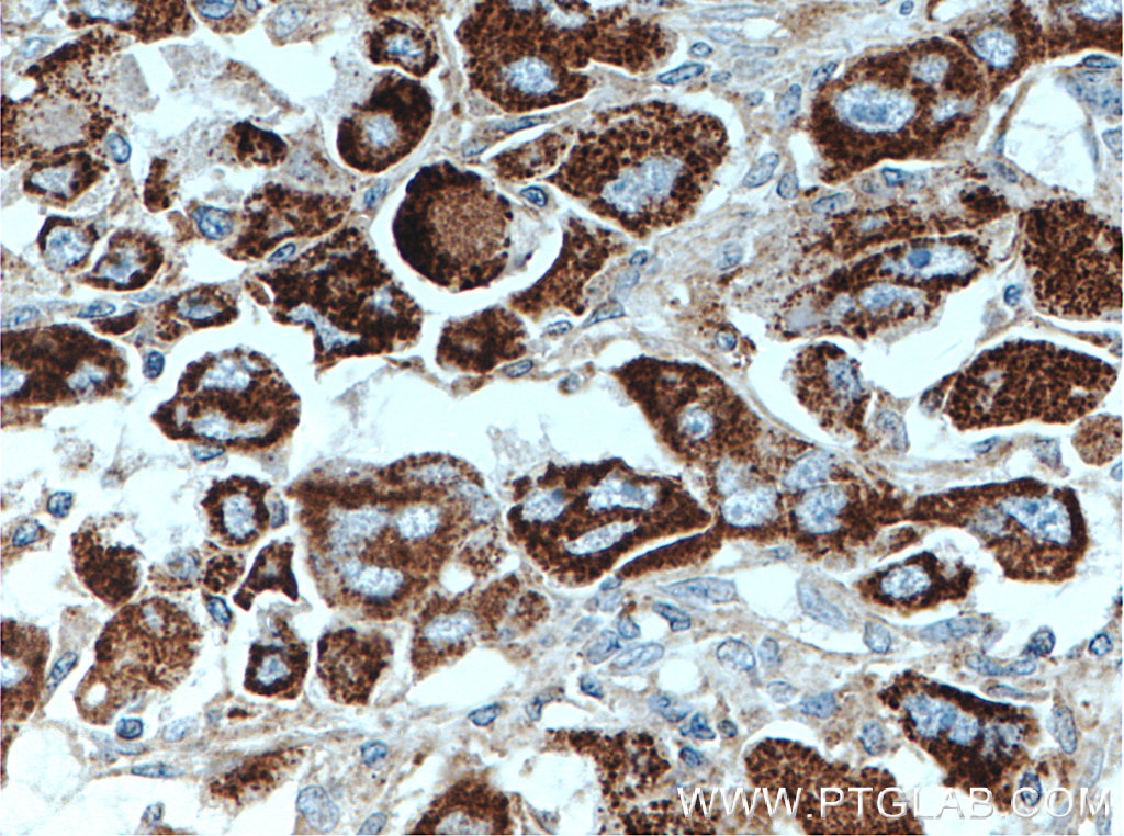 Immunohistochemistry (IHC) staining of human liver cancer tissue using SLC9A9 Monoclonal antibody (66577-1-Ig)