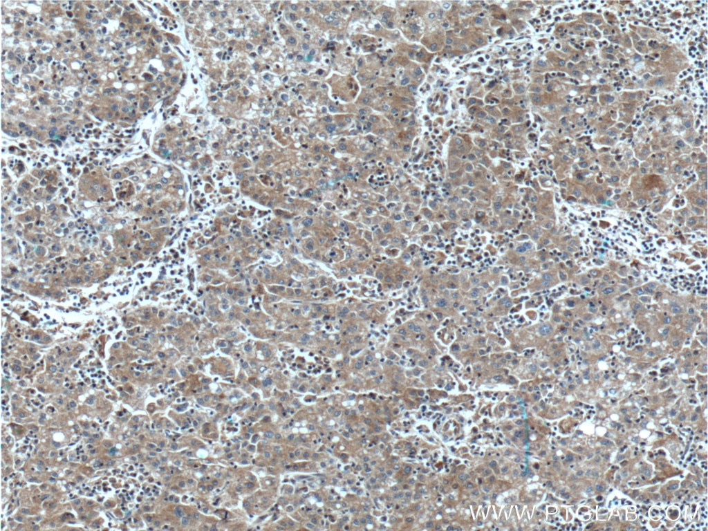 IHC staining of human liver cancer using 66381-1-Ig