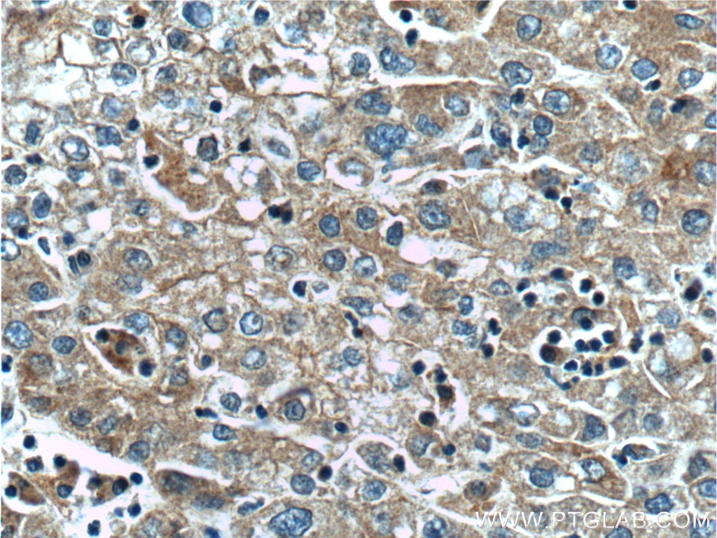 Immunohistochemistry (IHC) staining of human liver cancer tissue using SLCO1B3 Monoclonal antibody (66381-1-Ig)