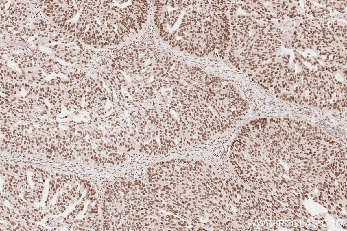 IHC staining of human ovary cancer using 26060-1-AP Immunohistochemistry (IHC) staining of human ovary cancer tissue using SLFN11 Polyclonal antibody (26060-1-AP)