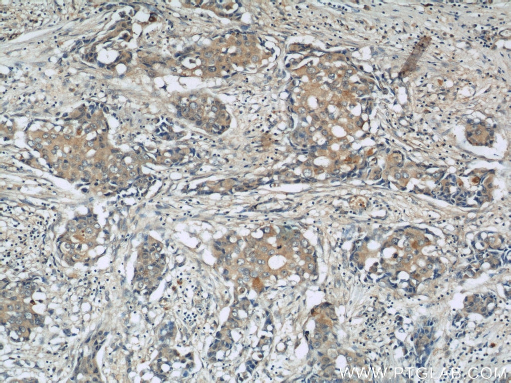 Immunohistochemistry (IHC) staining of human breast cancer tissue using SLIT2-Specific Polyclonal antibody (20217-1-AP)