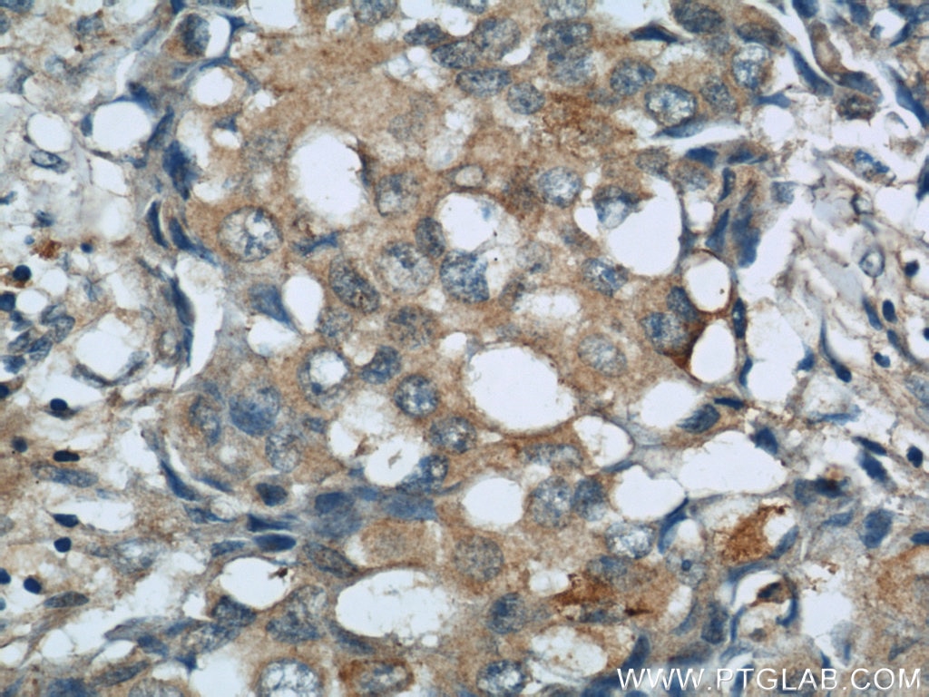 Immunohistochemistry (IHC) staining of human breast cancer tissue using SLIT2-Specific Polyclonal antibody (20217-1-AP)