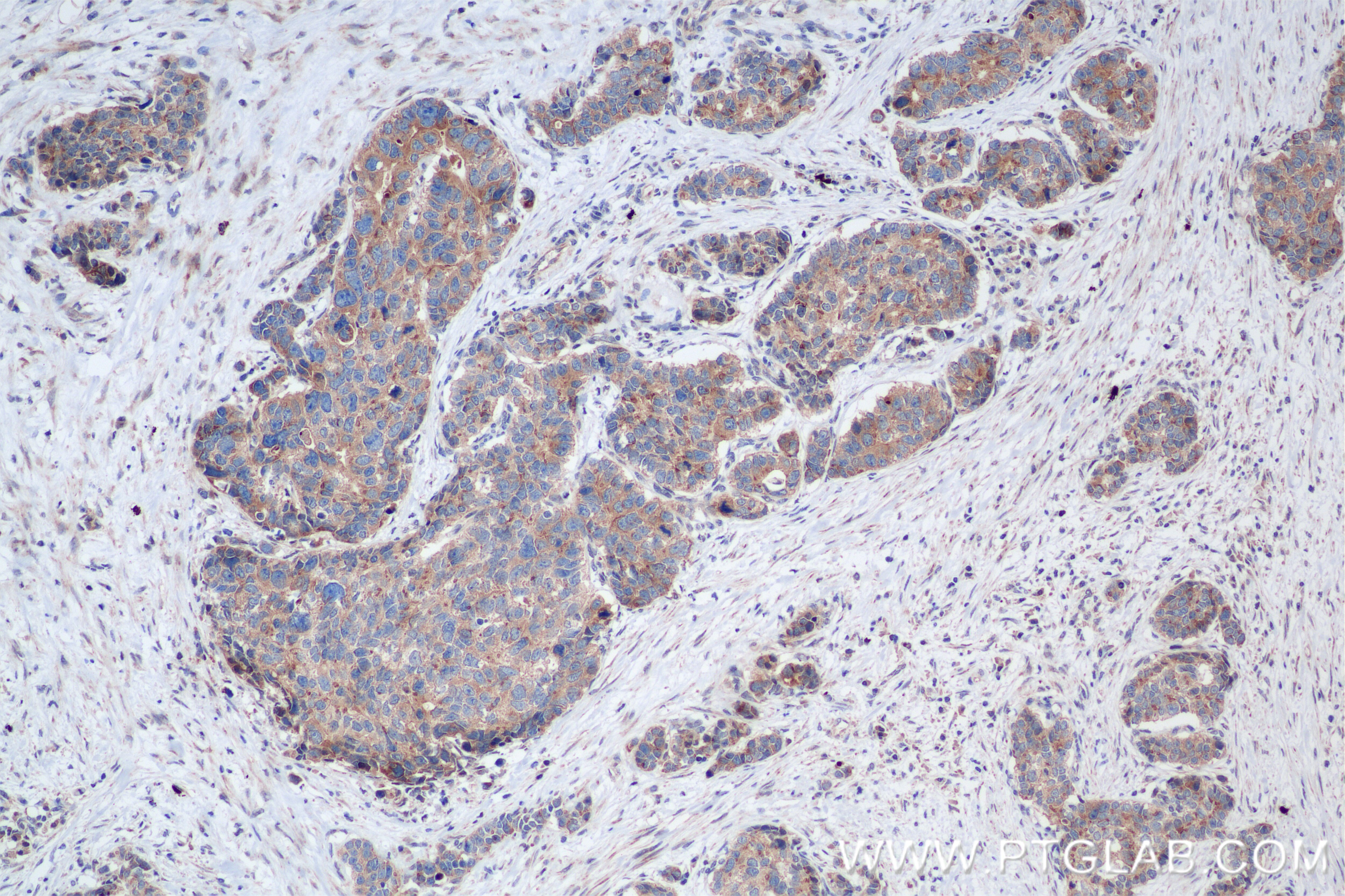 Immunohistochemistry (IHC) staining of human stomach cancer tissue using SLIT2-Specific Recombinant antibody (82725-4-RR)