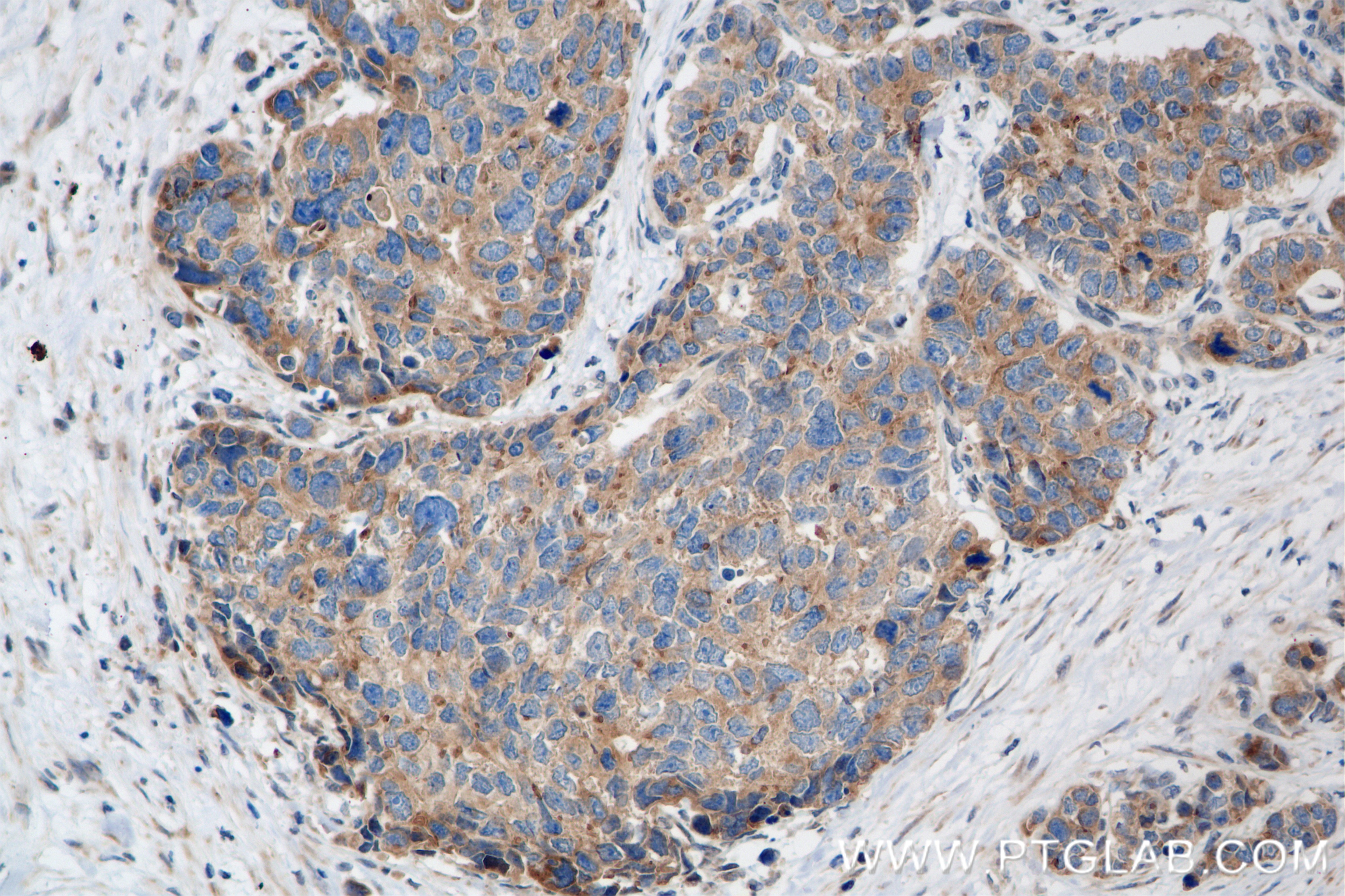 Immunohistochemistry (IHC) staining of human stomach cancer tissue using SLIT2-Specific Recombinant antibody (82725-4-RR)