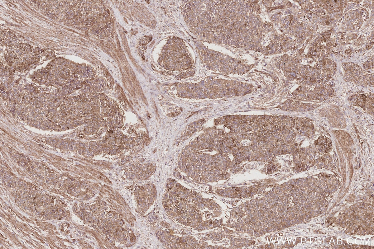 Immunohistochemistry (IHC) staining of human stomach cancer tissue using SLK Polyclonal antibody (19743-1-AP)