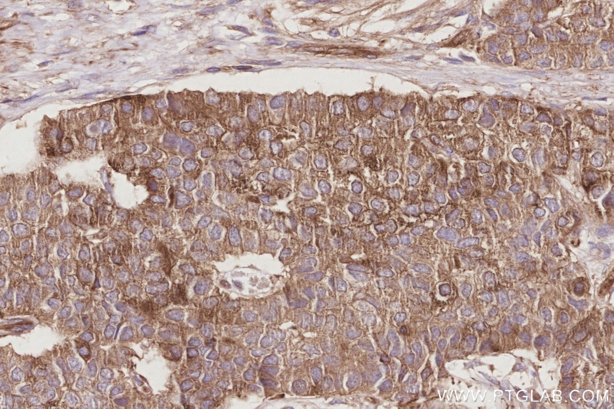 IHC staining of human stomach cancer using 19743-1-AP Immunohistochemistry (IHC) staining of human stomach cancer tissue using SLK Polyclonal antibody (19743-1-AP)