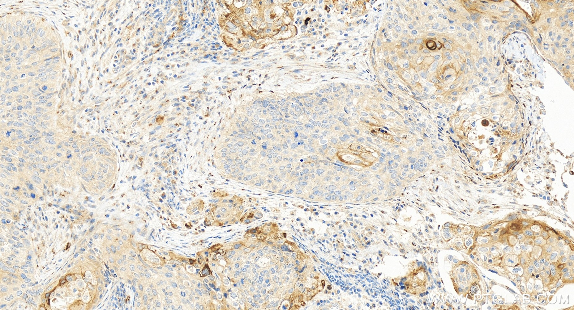 Immunohistochemistry (IHC) staining of human cervical cancer tissue using SLPI Recombinant antibody (83965-4-RR)