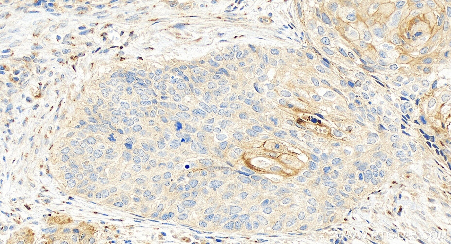 Immunohistochemistry (IHC) staining of human cervical cancer tissue using SLPI Recombinant antibody (83965-4-RR)