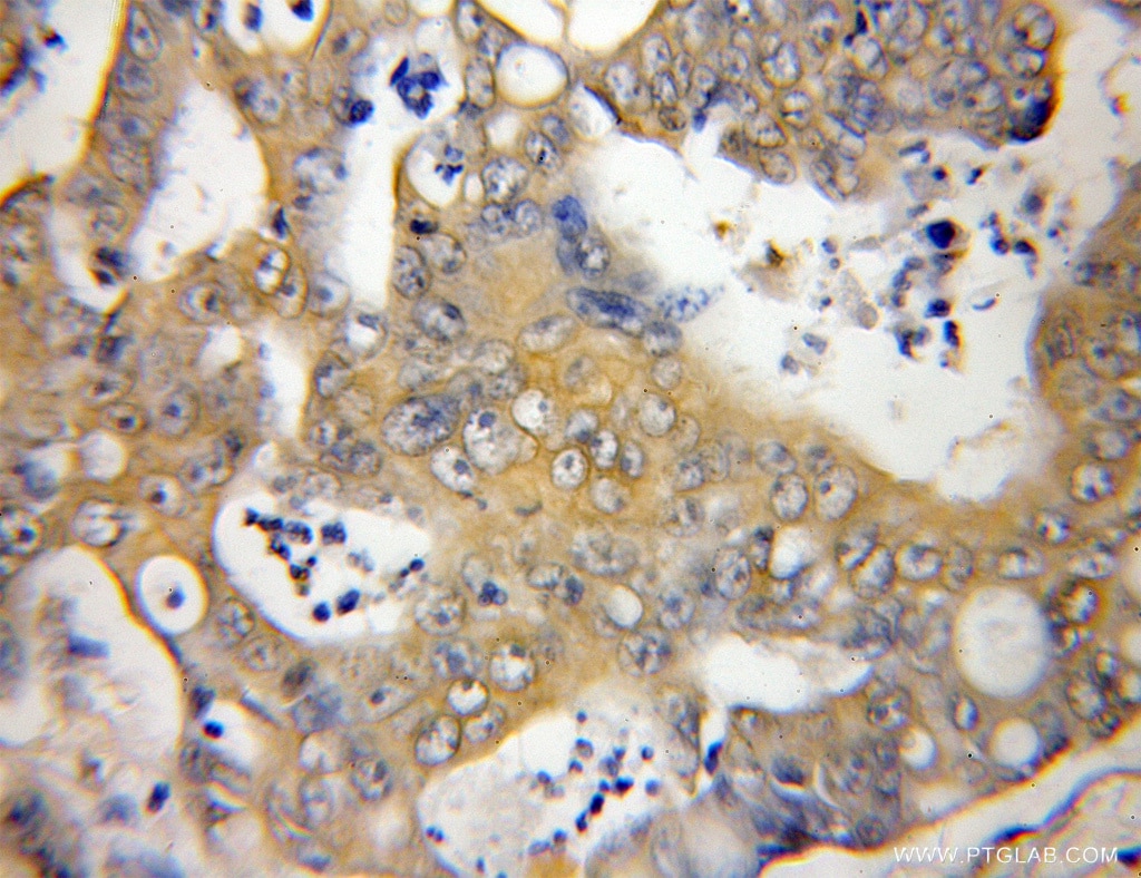 Immunohistochemistry (IHC) staining of human colon cancer tissue using SLU7 Polyclonal antibody (12050-1-AP)