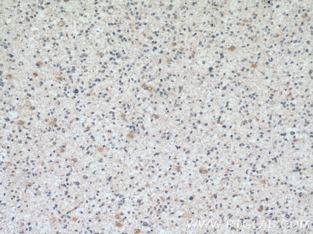 Immunohistochemistry (IHC) staining of human gliomas tissue using SMAD1 Monoclonal antibody (66559-1-Ig)