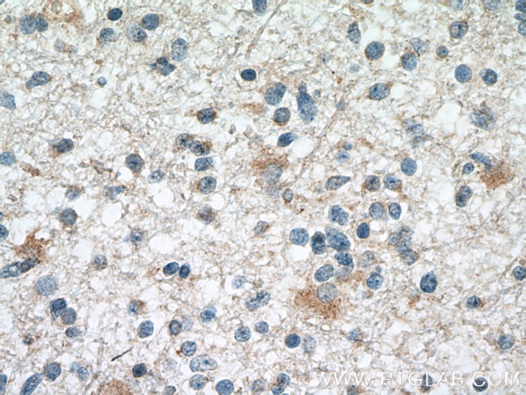 Immunohistochemistry (IHC) staining of human gliomas tissue using SMAD1 Monoclonal antibody (66559-1-Ig)