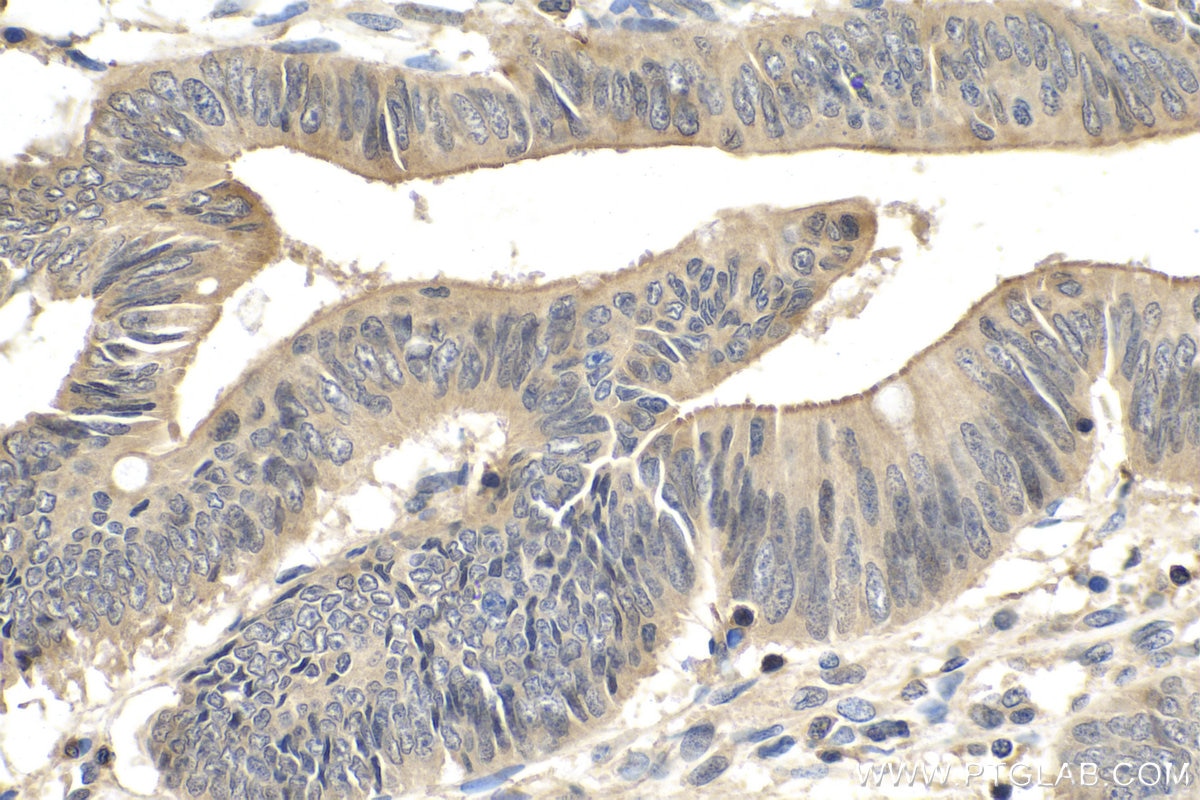 IHC staining of human colon cancer using 12570-1-AP
