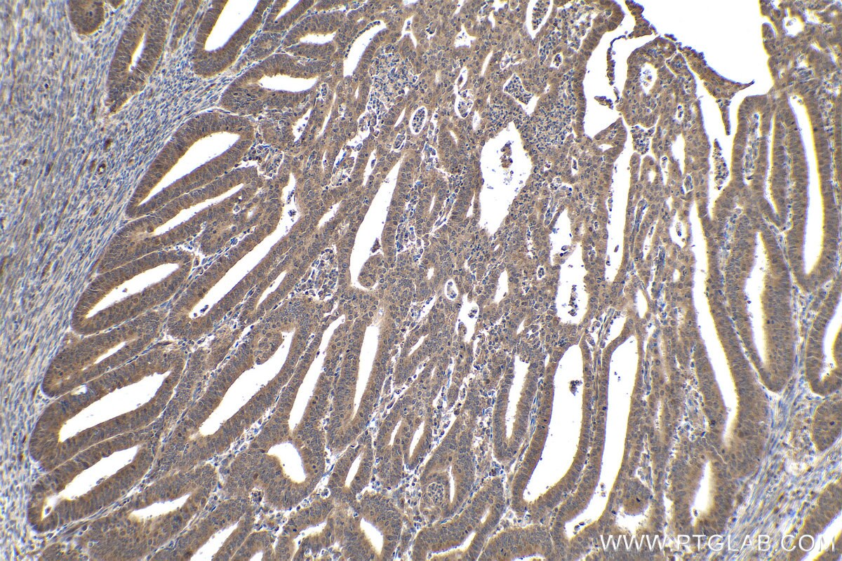 IHC staining of human endometrial cancer using 12570-1-AP