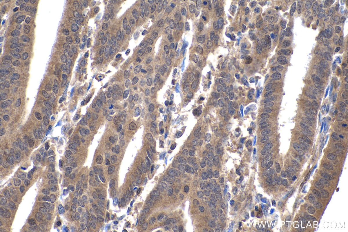 Immunohistochemistry (IHC) staining of human endometrial cancer tissue using SMAD2/3 Polyclonal antibody (12570-1-AP)