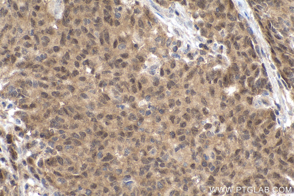 IHC staining of human stomach cancer using 12570-1-AP