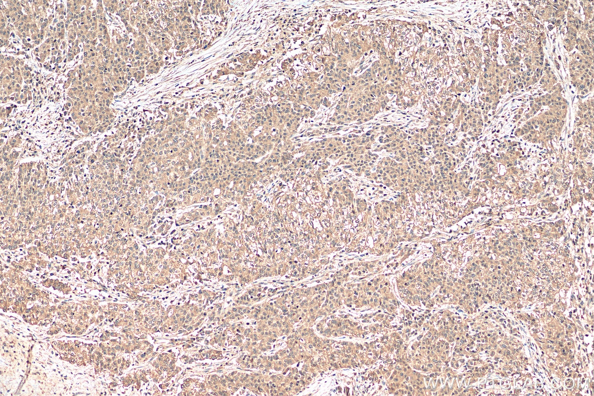 Immunohistochemistry (IHC) staining of human stomach cancer tissue using SMAD2 Polyclonal antibody (12570-1-AP)