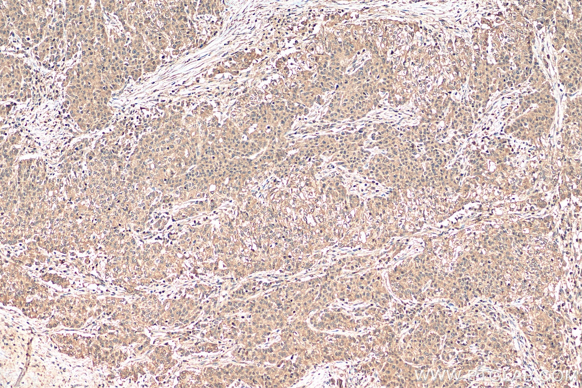 IHC staining of human stomach cancer using 12570-1-AP