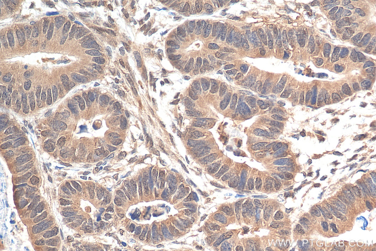 Immunohistochemistry (IHC) staining of human colon cancer tissue using SMAD2 Polyclonal antibody (12570-1-AP)