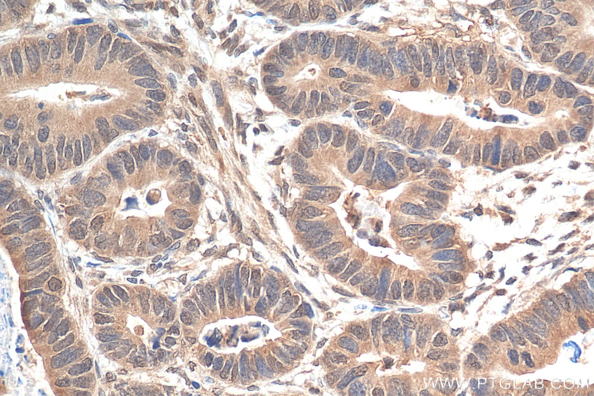 Immunohistochemistry (IHC) staining of human colon cancer tissue using SMAD2/3 Polyclonal antibody (12570-1-AP)