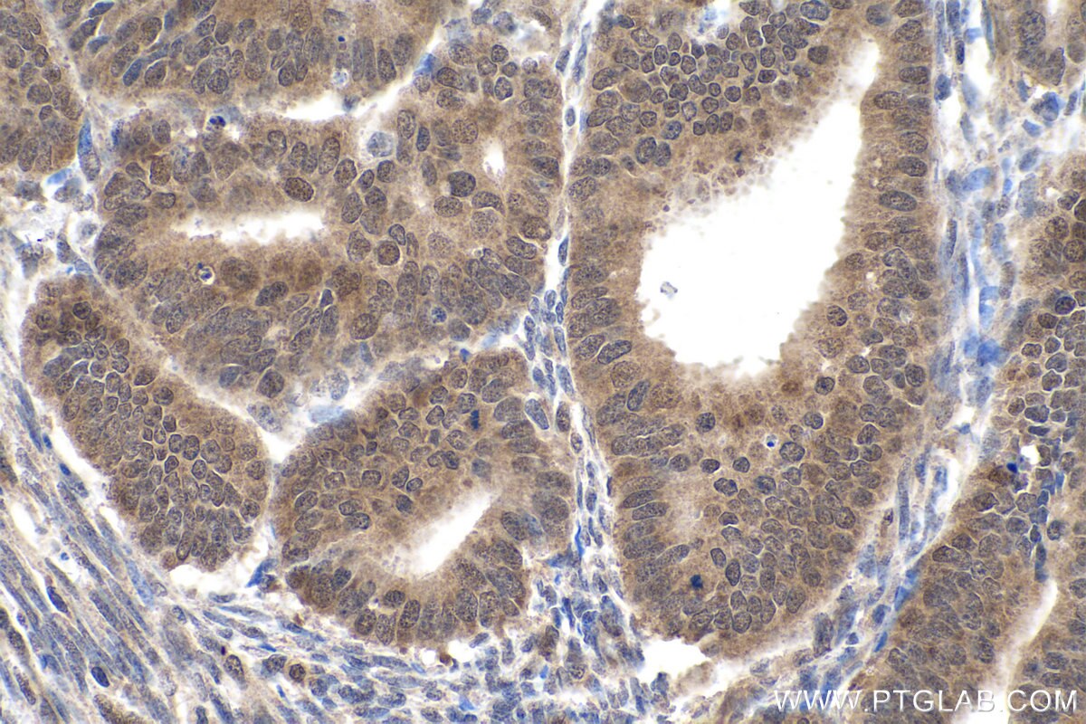 IHC staining of human endometrial cancer using 67343-1-Ig